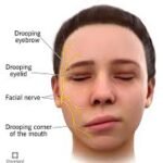 Bell’s Palsy-mycivilexam.com