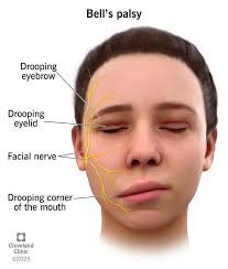 Bell’s Palsy-mycivilexam.com